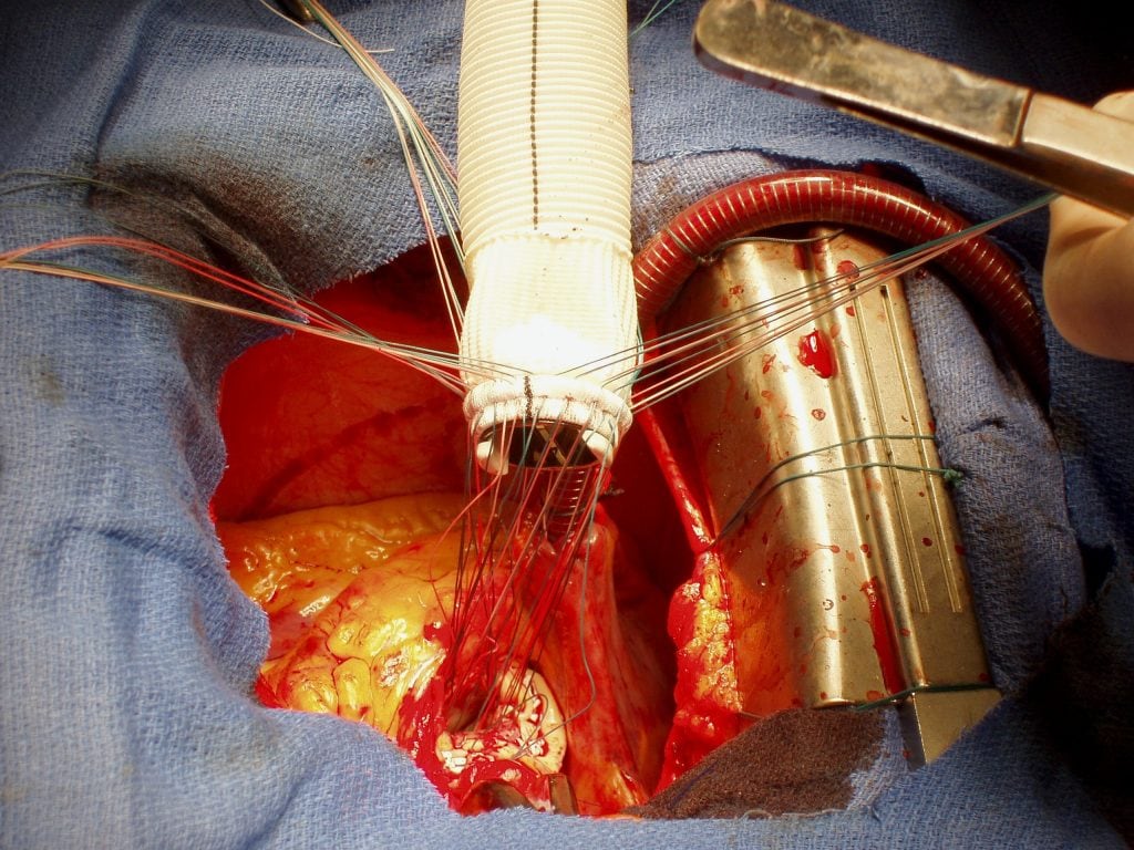 Opération aorte