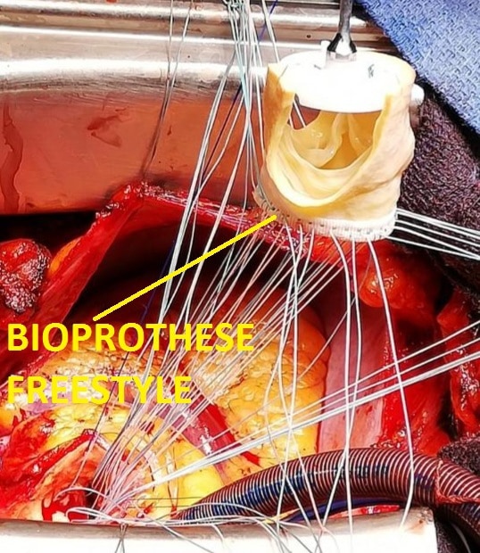 Bioprothèse