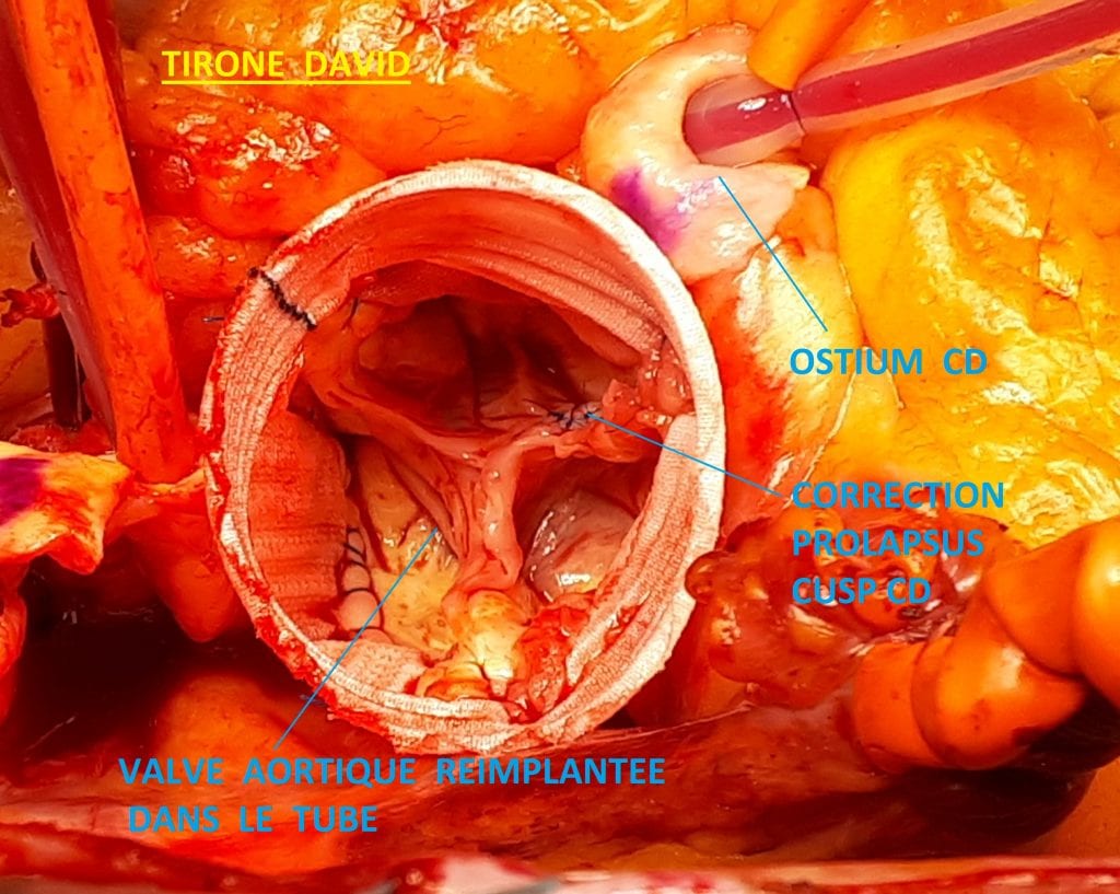 Pathologie de l'aorte