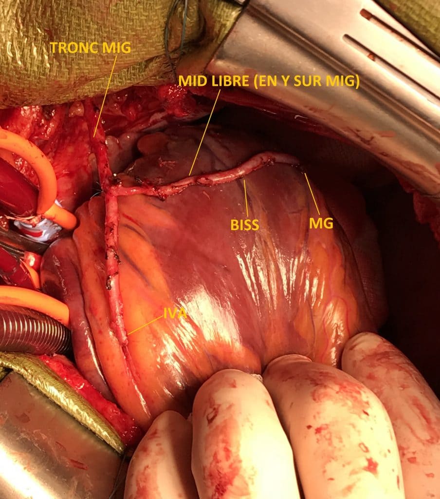 Pathologie coronaire