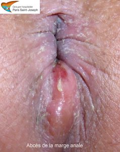 absces1