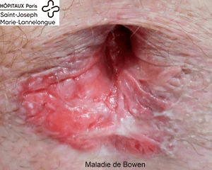 bowen