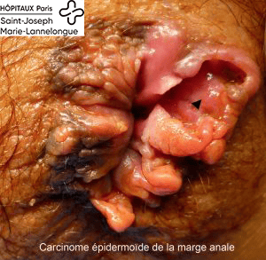 carcinome