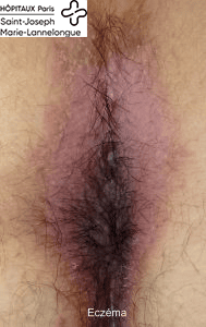 eczema